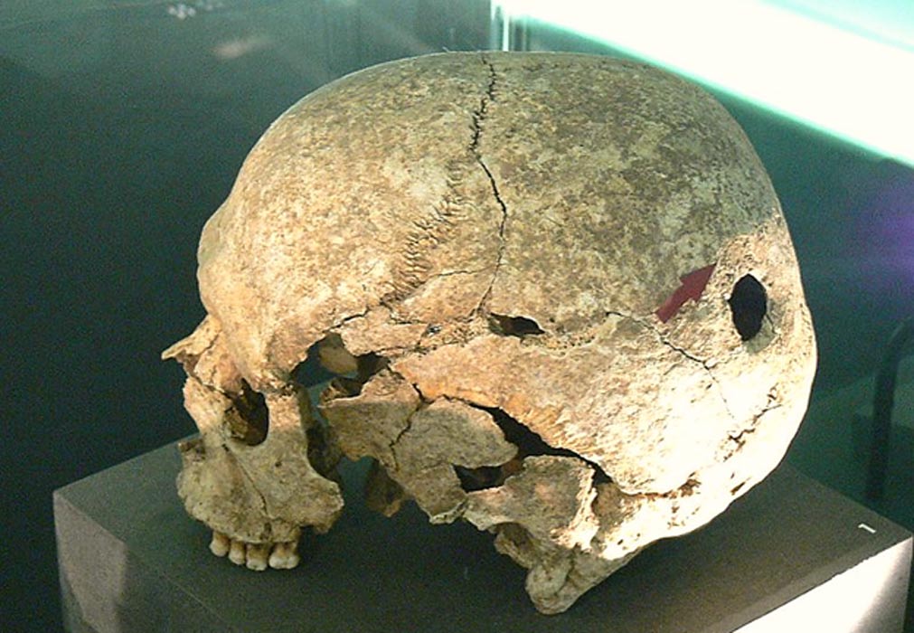 holes in the skull